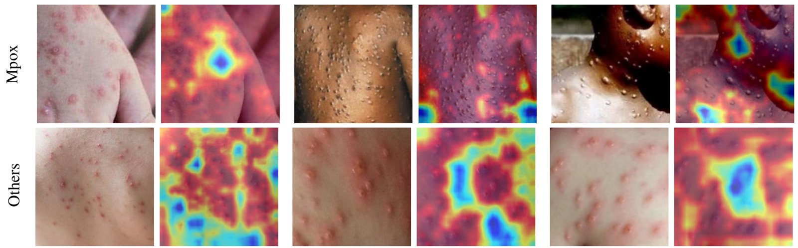 Skin lesion images next to Grad-CAM heatmaps for Mpox and other classes.
